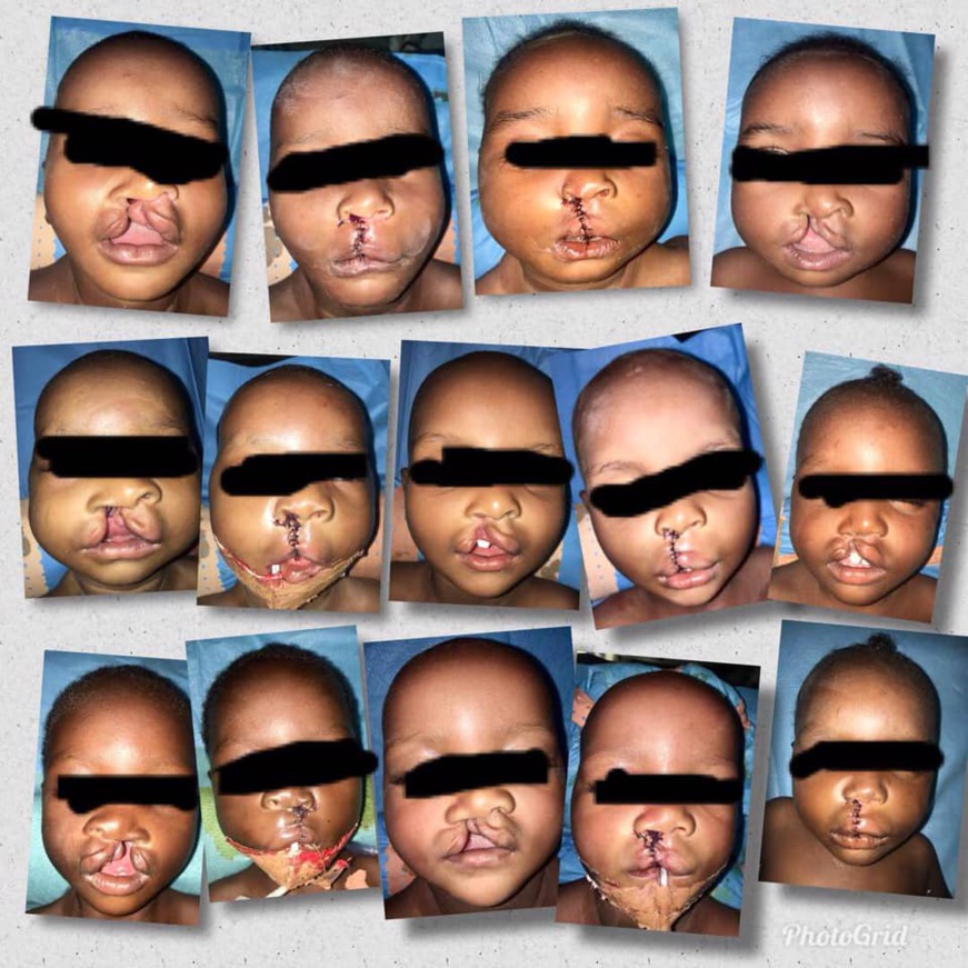 Tchad : 46 victimes de la malformation bec-de-lèvre opérées. © DR/FGC