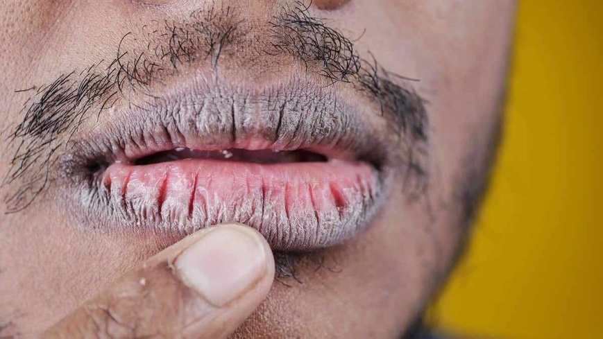 Tchad : avoir les lèvres gercées, un problème quotidien en période de froid Tchad : avoir les lèvres gercées, un problème quotidien en période de froid