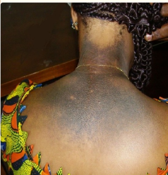 Tchad : La dépigmentation, un fléau aux conséquences désastreuses