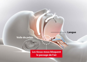 LE SYNDROME D’APNÉE DU SOMMEIL (SAS)