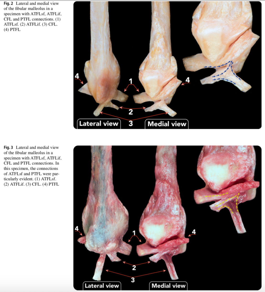 Vers une autre description des ligaments latéraux de la cheville avec connexions médiales