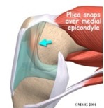 Douleurs antérieures du genou,  l’oubliée : la plica médiale