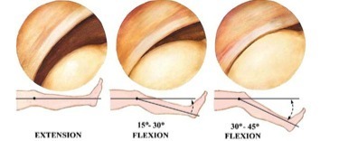 Douleurs antérieures du genou,  l’oubliée : la plica médiale