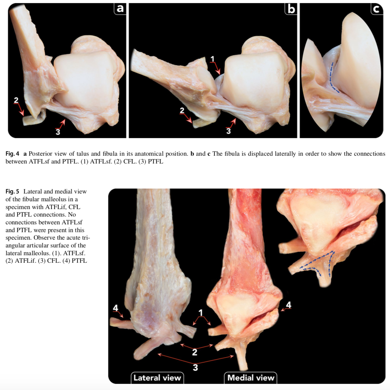 Vers une autre description des ligaments latéraux de la cheville avec connexions médiales