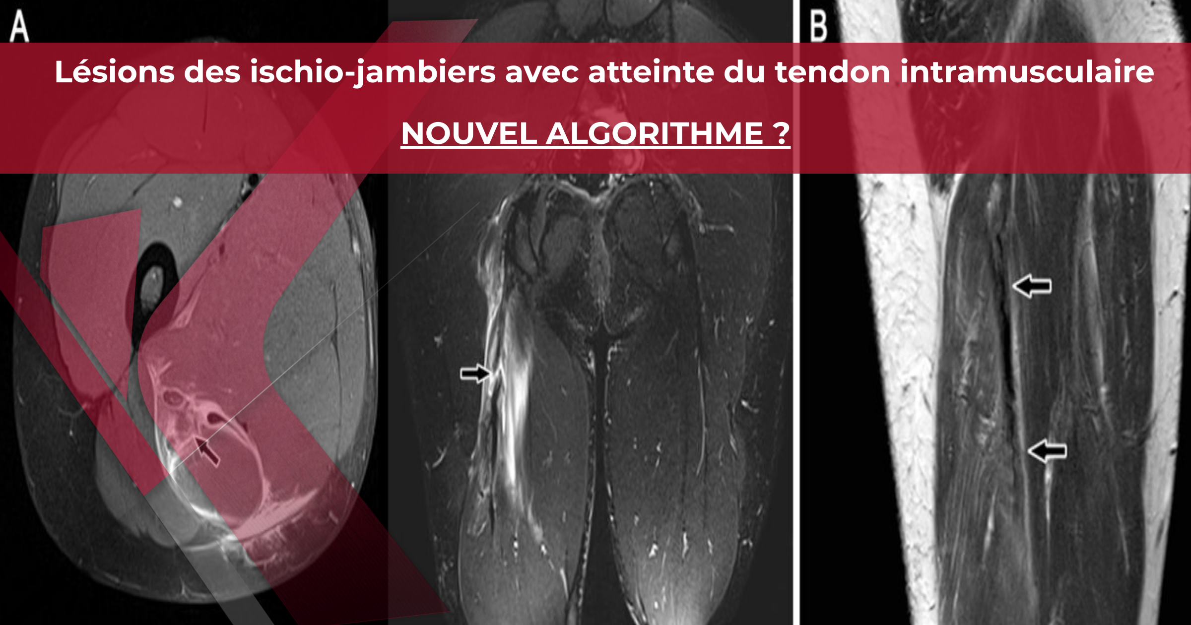 Lésions musculaires des ischiojambiers et proposition d’un nouvel algorithme pour les lésions Lésions musculaires des ischiojambiers et proposition d’un nouvel algorithme pour les lésions