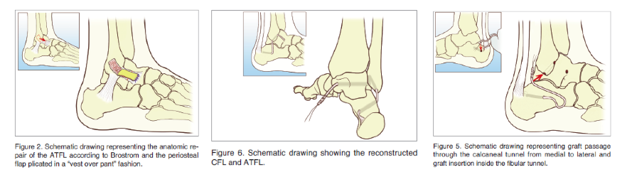 La cheville, articulation complexe, est sujette à diverses instabilités  parfois chroniques, non ligamentaires, qu'il faut diagnostiquer et dont le  traitement ne sera pas de réparer les ligaments - chirurgie pied cheville 