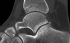 Évaluation de la prévalence d’un os trigone et des lésions ostéochondrales du Talus, par IRM de la cheville chez des patients présentant un syndrome de conflit de cheville.