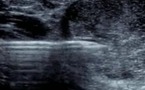 PRP et tendon d'Achille : échographie en directe.
