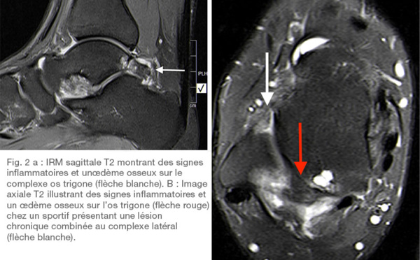 L'instabilité latérale chronique de la cheville augmente le risque de chirurgie chez les athlètes atteints du syndrome de l'os trigone