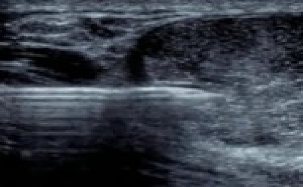 PRP et tendon d'Achille : échographie en directe.