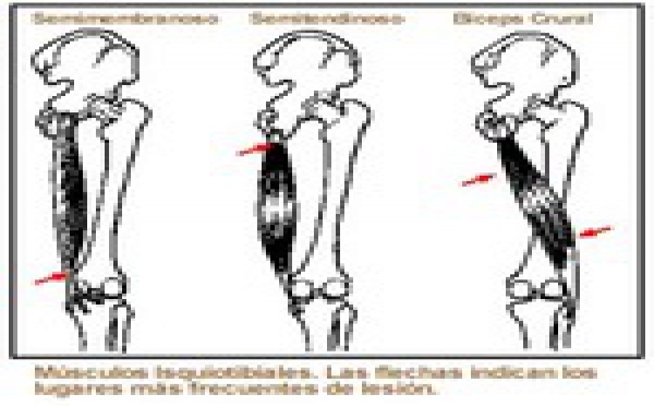 Lesion musculaire , une nouvelle étude longitudinale dans le foot pro.