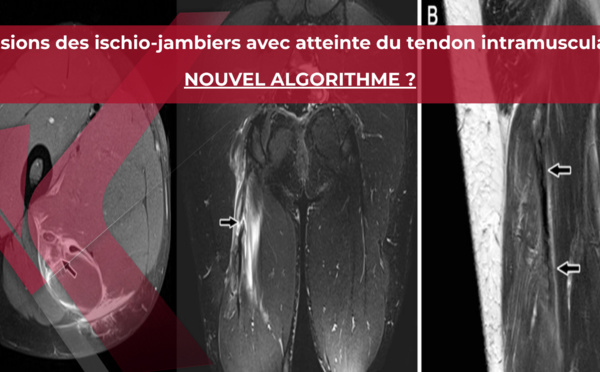 Lésions musculaires des ischio-jambiers et proposition d’un nouvel algorithme pour les lésions spécifiques avec atteinte du tendon intramusculaire.