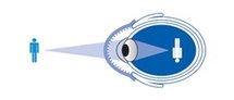 chirurgie des yeux au laser