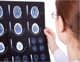 Alzheimer, la maladie du cortex cérébral
