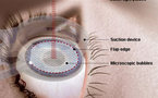 La chirurgie des yeux au laser continue d’évoluer en France