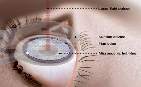 La chirurgie des yeux au laser continue d’évoluer en France