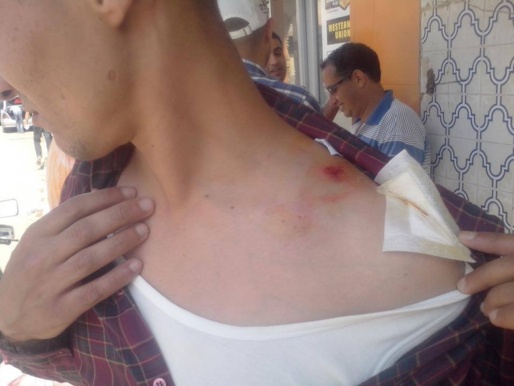 un jeune militant rifain bléssé lors de la répression menée par le Makhzen (photo Nadorcity)