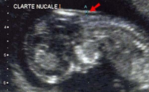 Tuviret : des spécialistes plaident une prise en charge précoce de l’enfant atteint de trisomie 21