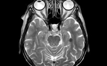 Une malade atteinte d'Alzheimer sort sans surveillance de l'hôpital