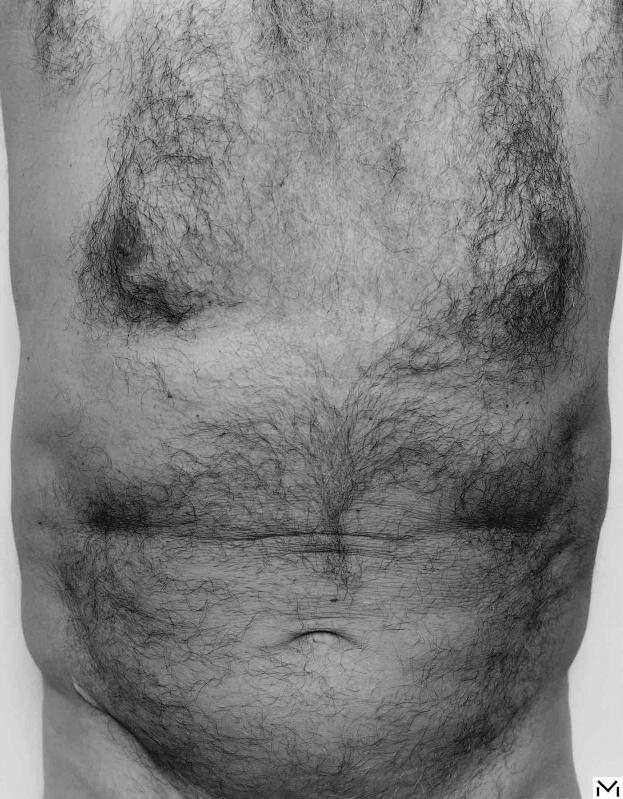 Torso Front, 1984 ©The John Coplans Trust
